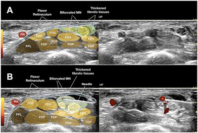 Commentary: Ultrasound-Guided Triamcinolone Acetonide Hydrodissection for Carpal Tunnel Syndrome: A Randomized Controlled Trial